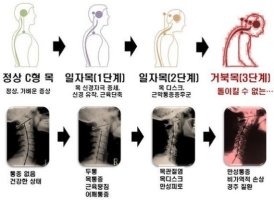 거북목스트레칭3