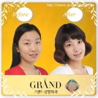 쌍꺼풀재수술비용4