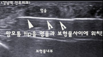 거대섬유선종1