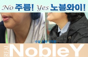 목주름수술4