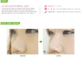 강남코필러잘하는곳2