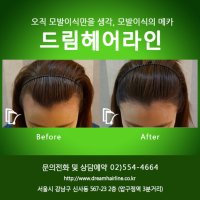 머리카락이식수술6