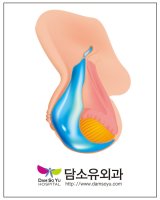 음낭수종3