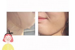 리프팅시술가격4