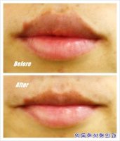 입술축소수술1