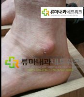 복숭아뼈통증5