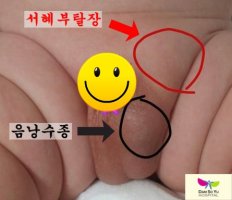 음낭수종5