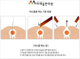등여드름1