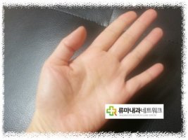 손가락관절염증상2