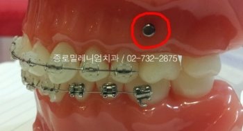 치아교정견적5