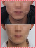 보톡스저렴한곳1