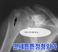 어깨인대파열4