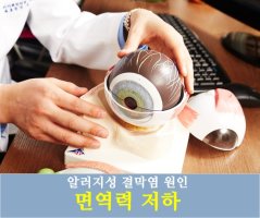 알러지성결막염3