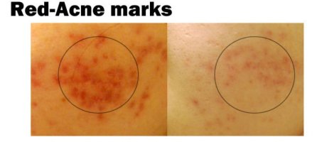 여드름빨간자국1