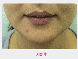 얼굴리프팅수술3