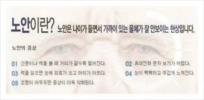 노안수술가격2