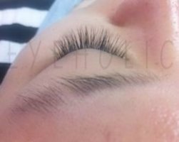속눈썹증모술5