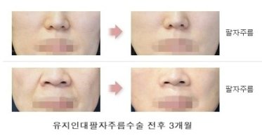 팔자주름수술1