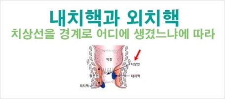 항문에이상한게생겼습니다1