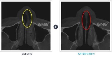 비중격수술비용3