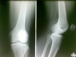 무릎연골연화증2