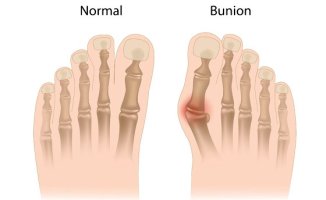 무지외반증치료4