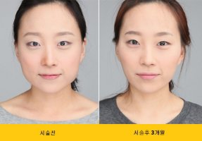 얼굴비대칭교정1