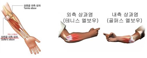 테니스엘보치료법4