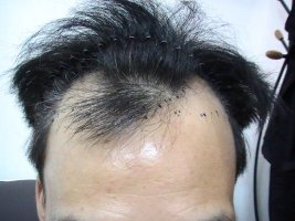 청주모발이식4