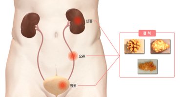 요로결석2