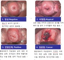 자궁경부암검사비용1