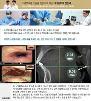 수면무호흡증수술1