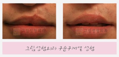 구순구개열수술2