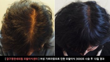 가르마모발이식2