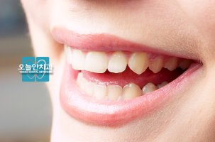 웃을때잇몸1