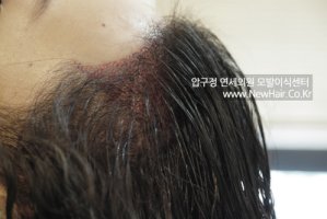 여성헤어라인비용3