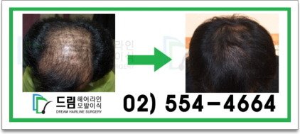 모발이식전문센터1