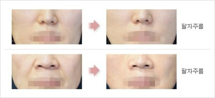 팔자주름수술2