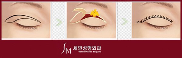 상안검성형술3