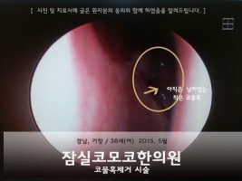 코물혹수술2