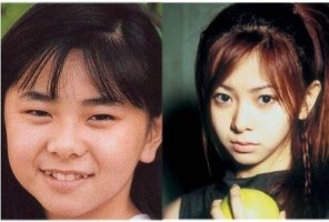 사각턱수술회복기간3