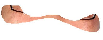 오타모반치료비용4