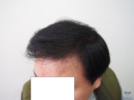 모발이식7개월2