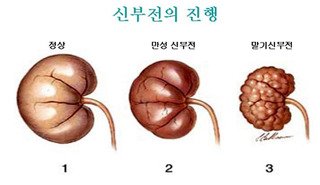 만성신부전5