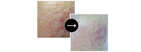 여드름흉터없애기2