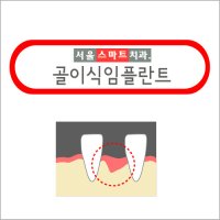 골이식임플란트5