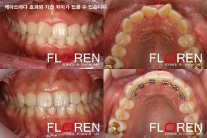 부분치아교정3