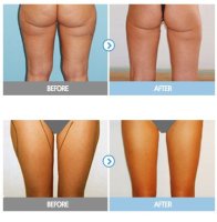 지방용해주사비용4