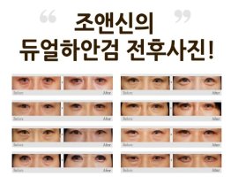 눈밑주름없애는방법3