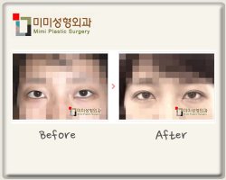 눈성형외과유명한곳3